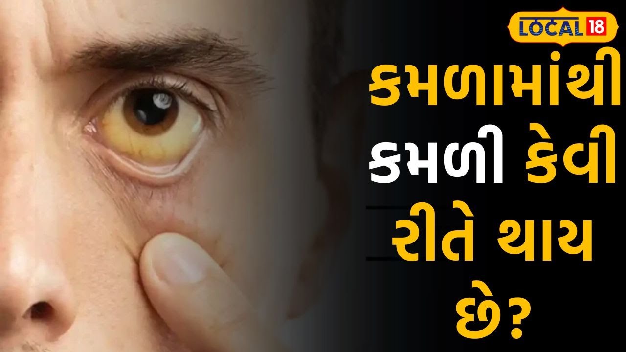 Health: કમળામાંથી કમળી કેવી રીતે થાય છે? તબીબે જણાવ્યું કારણ |#local18