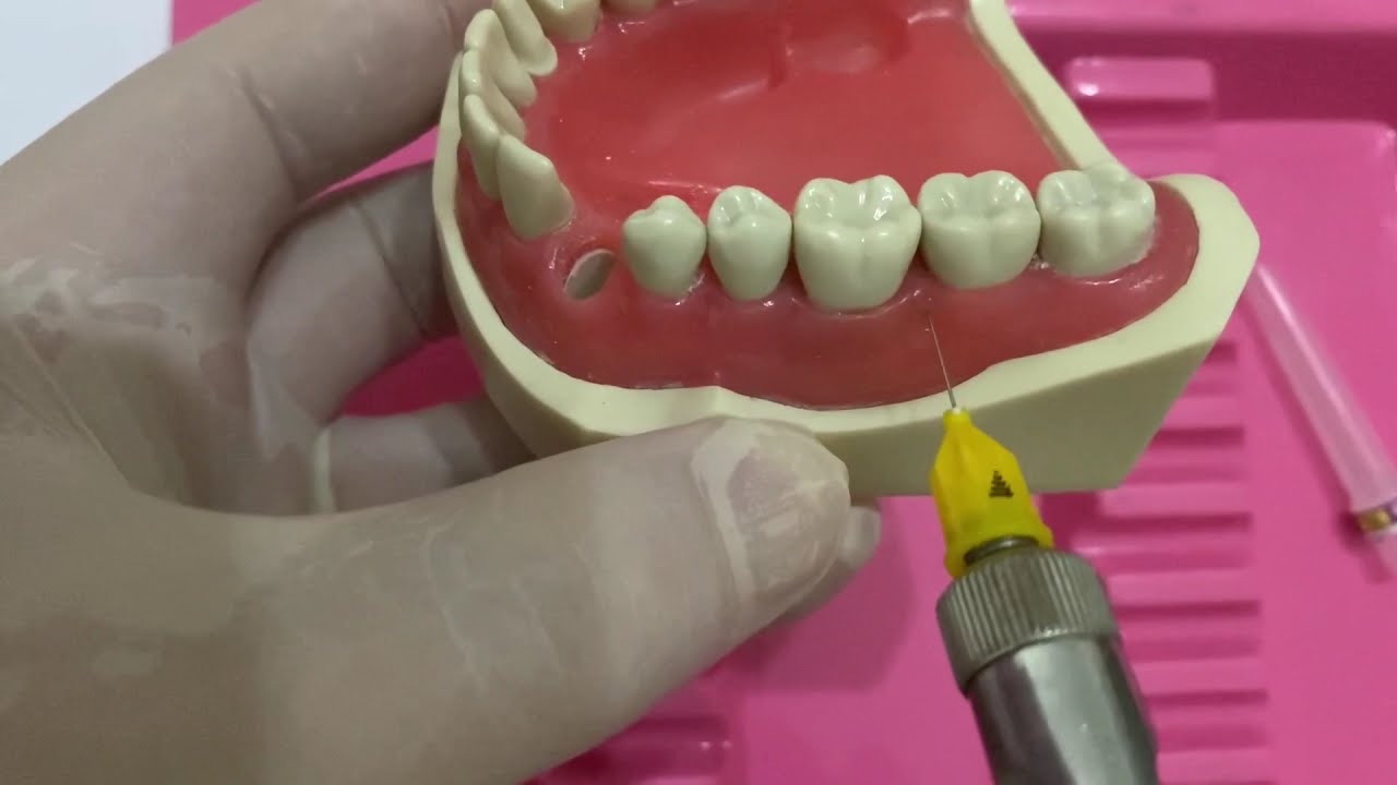 The local anaesthesia in pediatric dentistry: intrapapillary anaesthesia