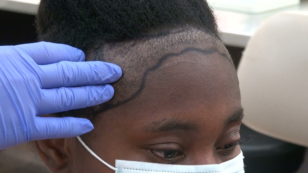 Can You Fix A Failed Hair Transplant on African American Woman? by Dr. Diep