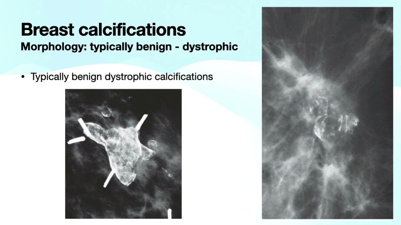 Breast Calcifications Part 1 | Free Radiology CME