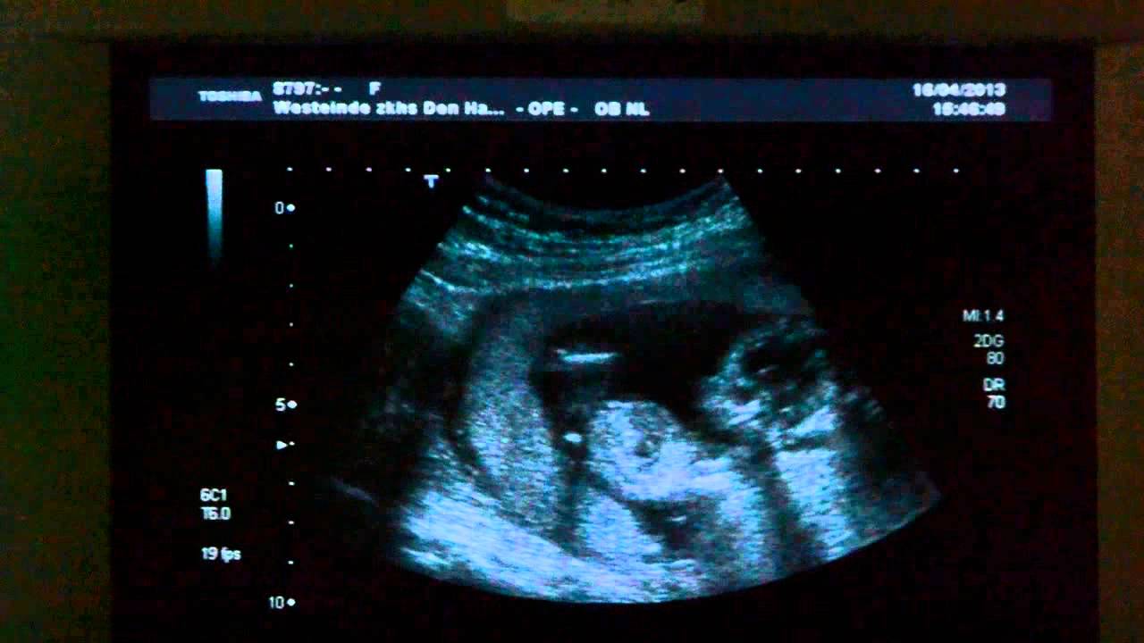 Identical twins 13 weeks ultrasound