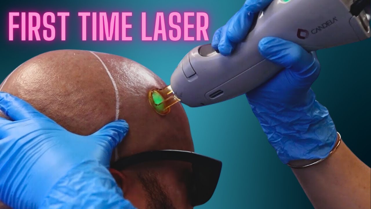 FIRST TIME LASER HAIR REMOVAL ON SCALP | HE FOUND ME ON YOUTUBE!