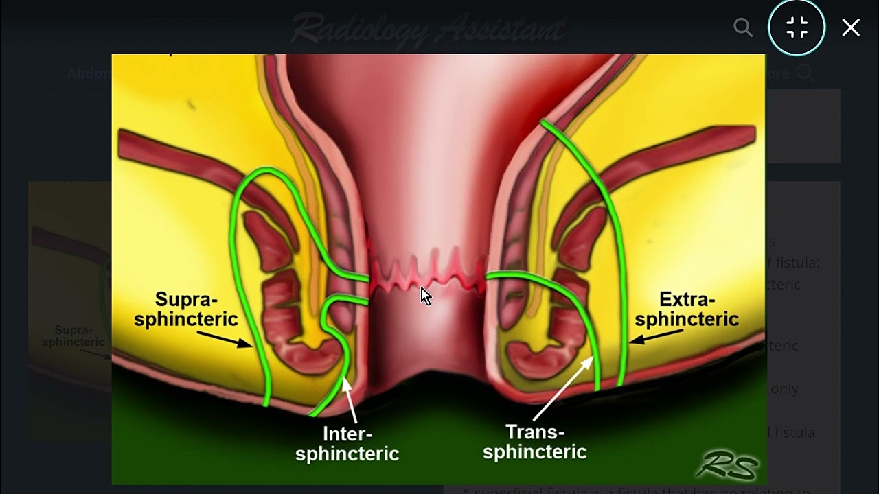 تشخيص النواسير حول الشرج بالرنين Perianal Fistulas
