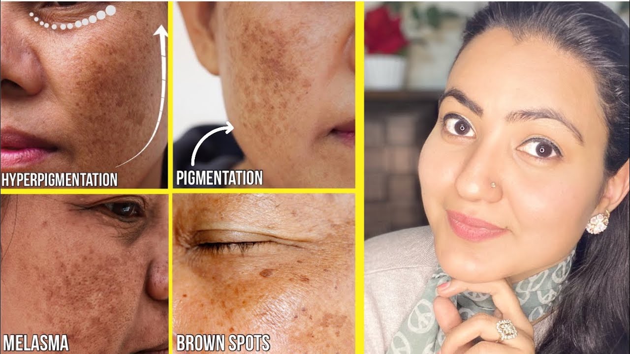 मुश्किल से मुश्किल MELASMA झाइयाँ HYPERPIGMENTATION BROWN SPOTS का इस तरीके से करें 100% इलाज
