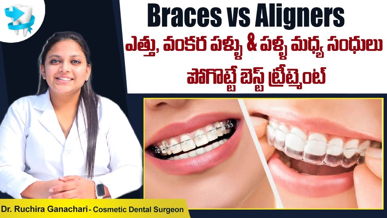 వంకర పళ్లకు బెస్ట్ ట్రీట్మెంట్ || Braces vs Aligners - Which is Best? || Eledent Dental Hospitals