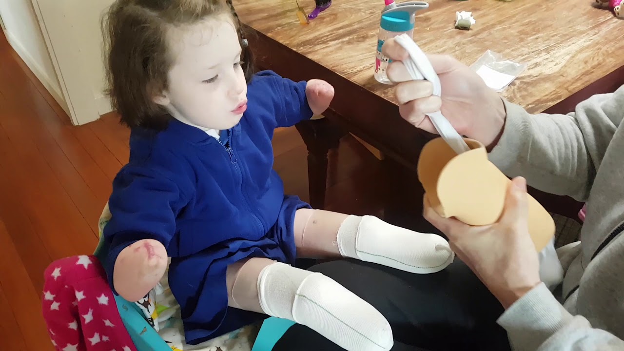 Putting on Mia's prosthetic legs.