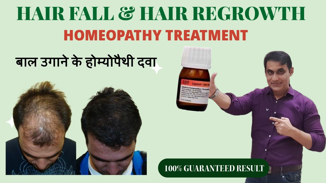 Hairfall and Hair Regrowth Treatment || Hair fall Control: Best Homeopathic medicines R89.