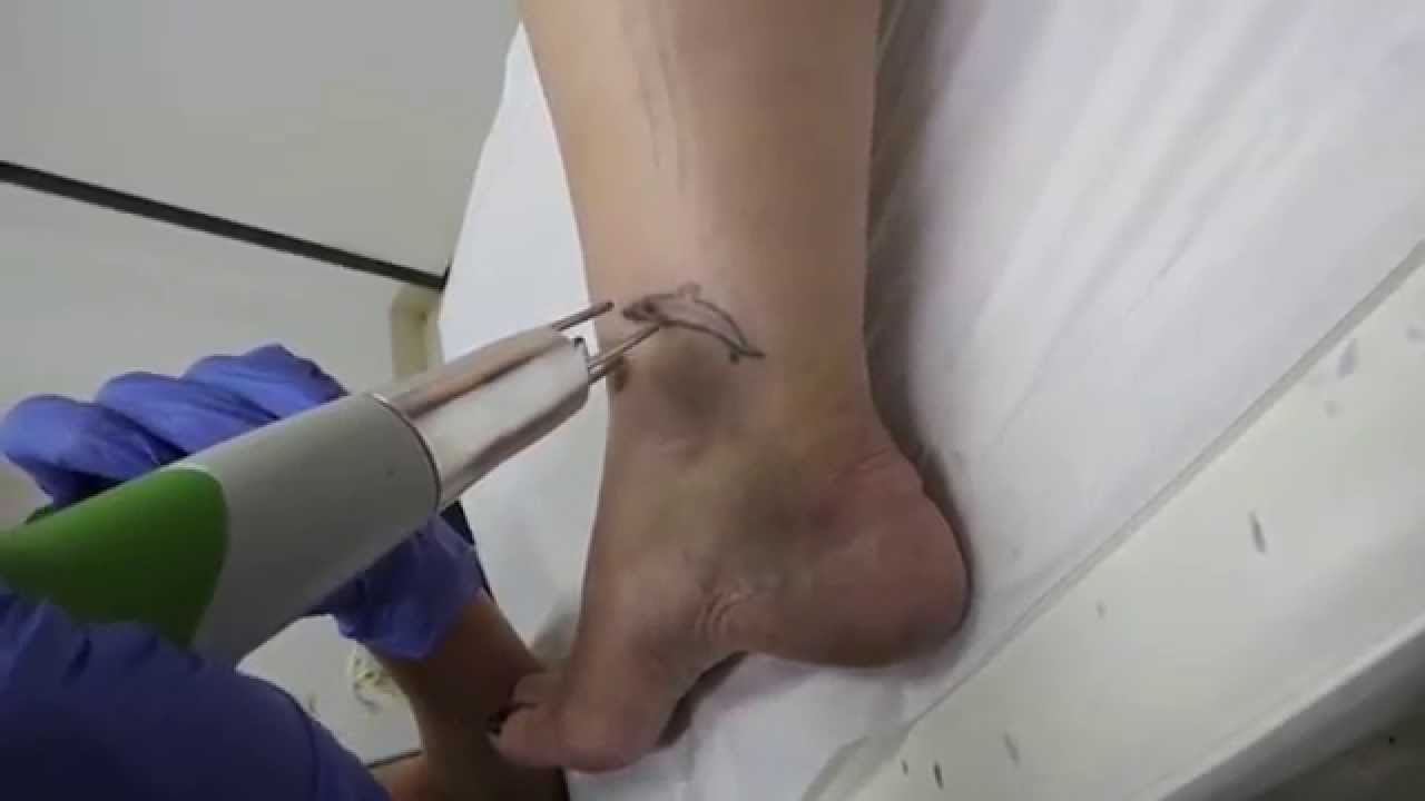 Dolphin Tattoo Removal on Ankle - Second Treatment