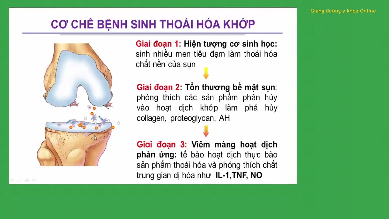 CẬP NHẬT CHẨN ĐOÁN VÀ ĐIỀU TRỊ THOÁI HÓA KHỚP | TS. Lê Thị Liễu