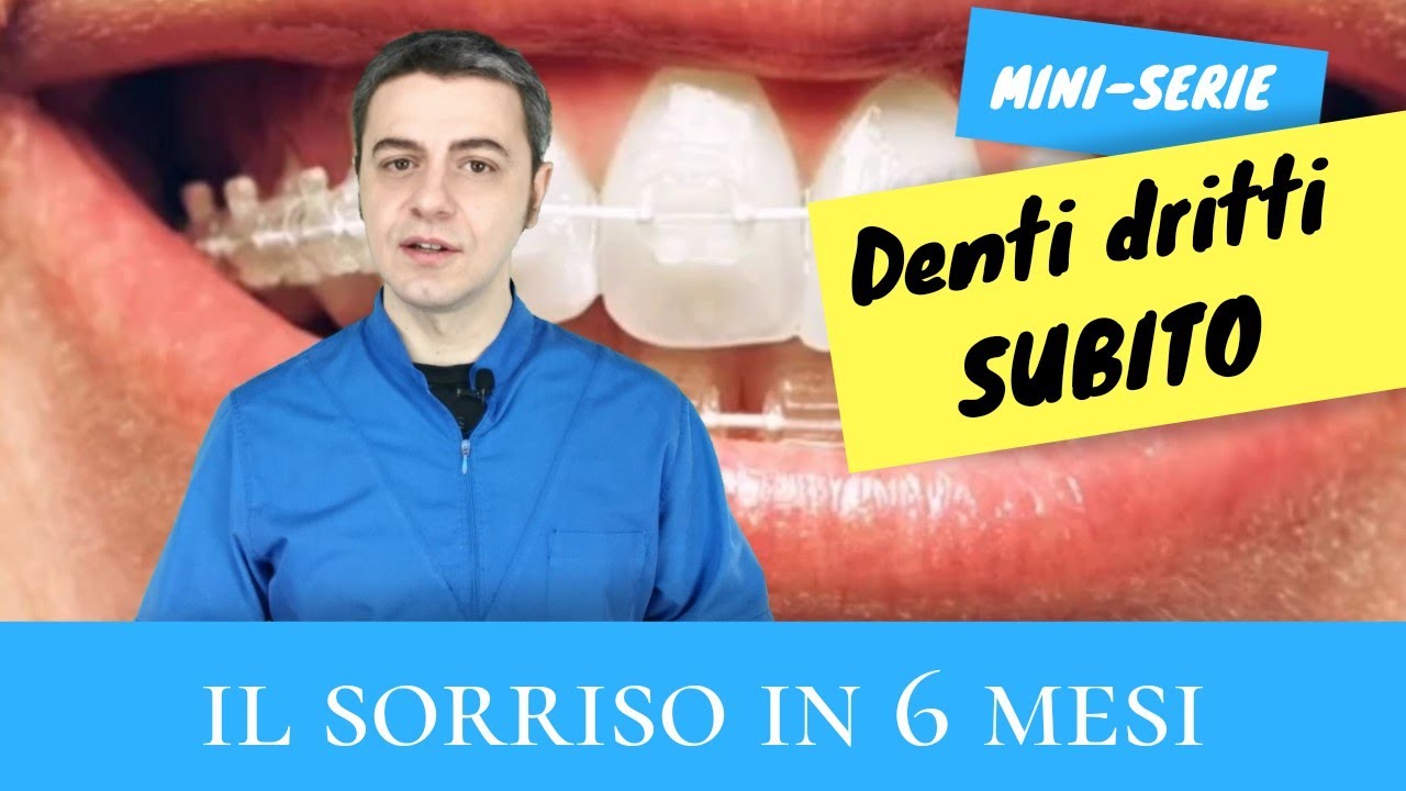 Denti dritti subito : 