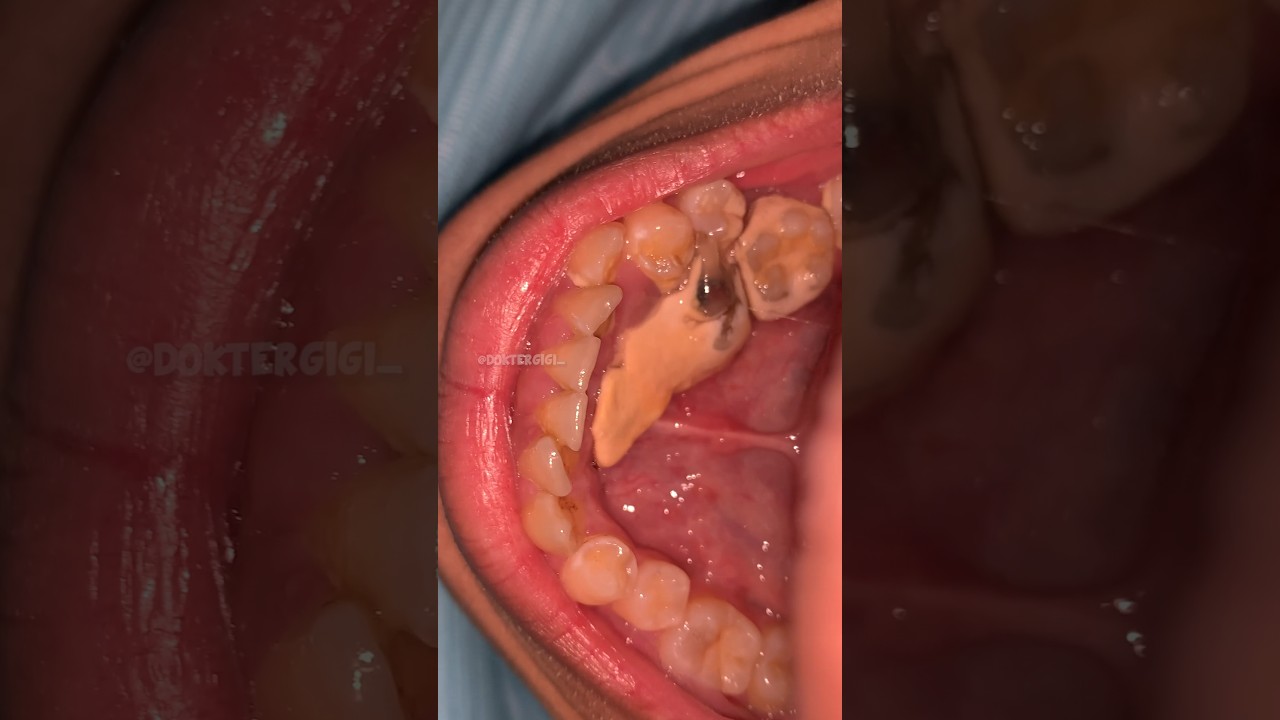 This isn&rsquo;t just a dental cleaning... it&rsquo;s a tartar extraction mission!