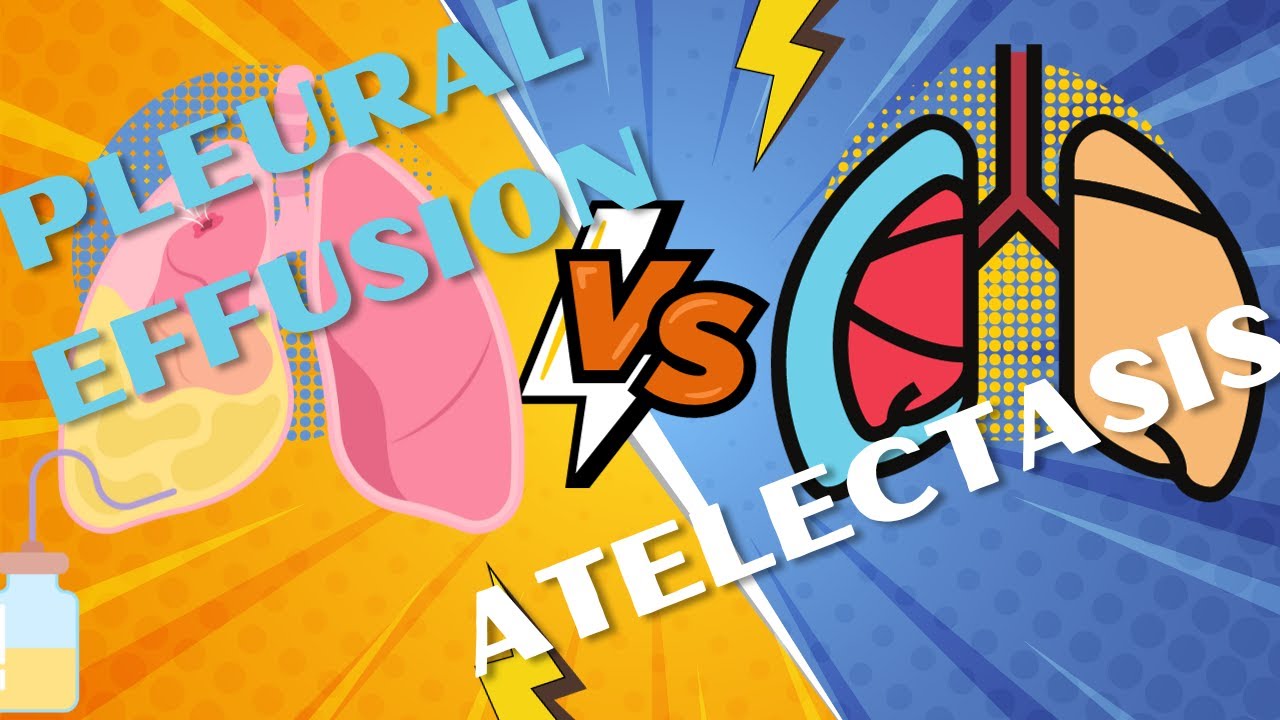 Atelectasis vs pleural effusion on X-ray
