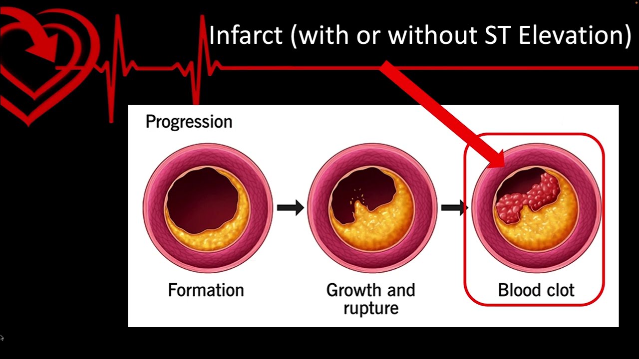 Acute Coronary Syndromes for ACLS 2020