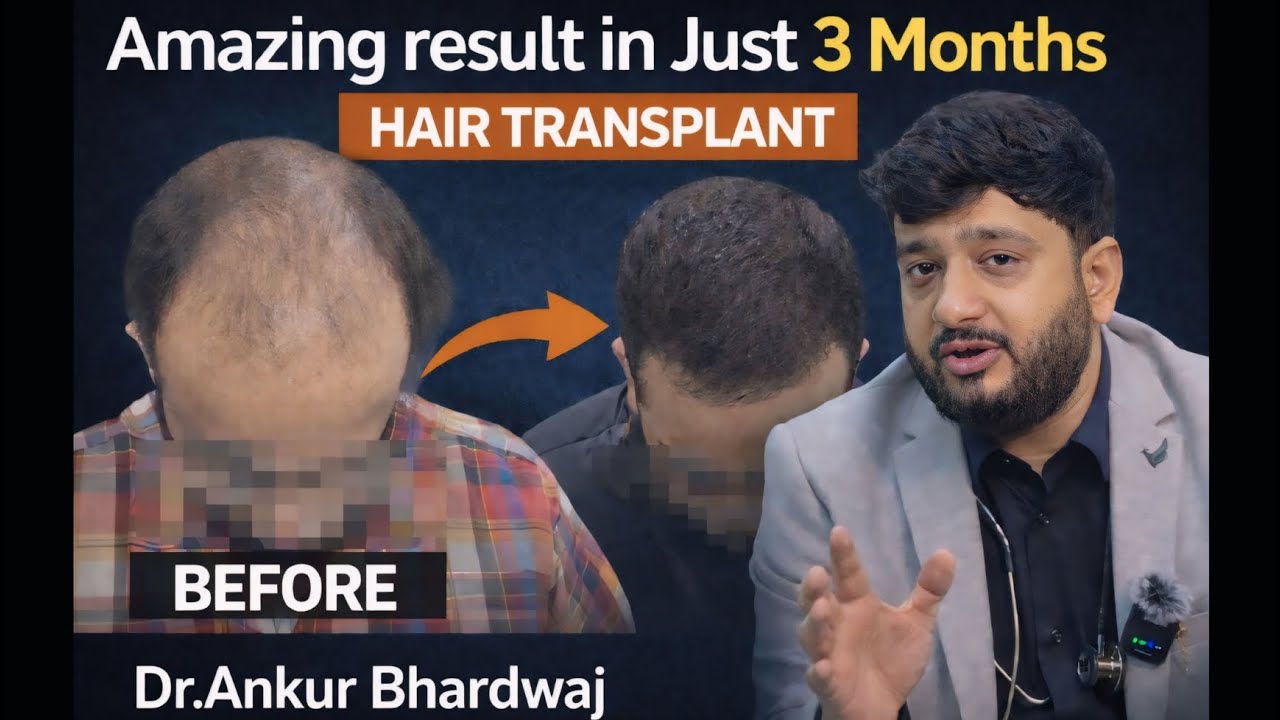Amazing result In Just 3 Months By DR.Ankur Bhardwaj | Cosmo Experts Clinic |