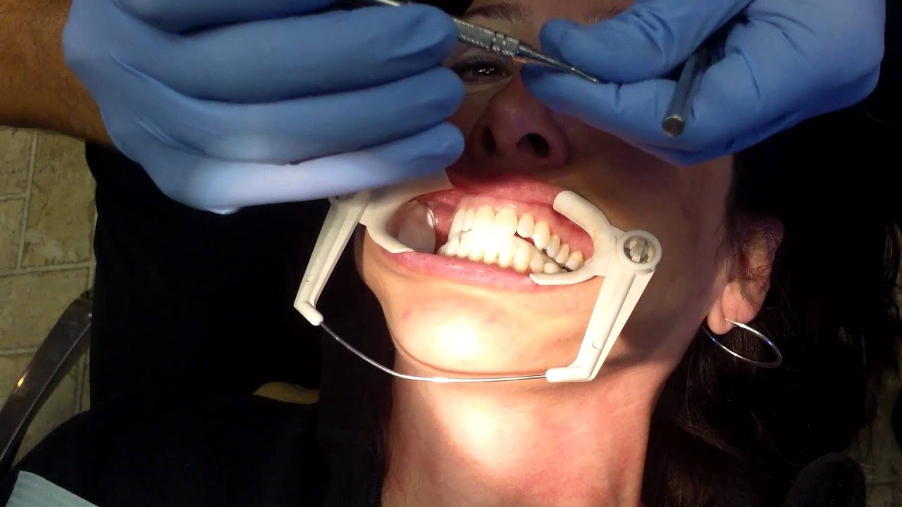 Getting Braces at Orthodontist Dr Don Wilson Novato CA