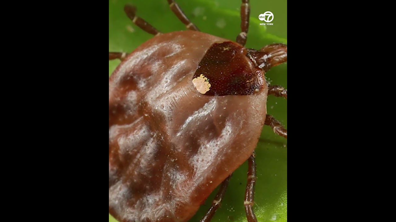 What to know after NJ man 1st confirmed death linked to a meat allergy spread by ticks