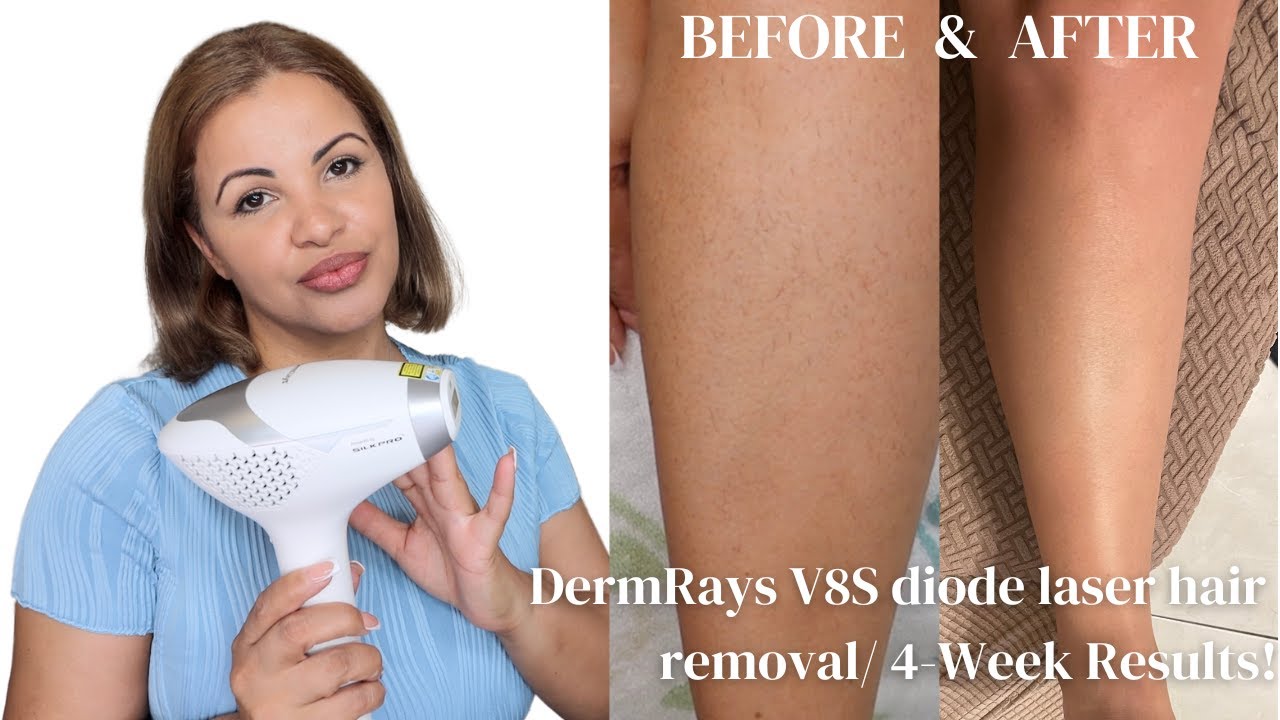 DermRays V8S diode laser hair removal: 4 Week Results!
