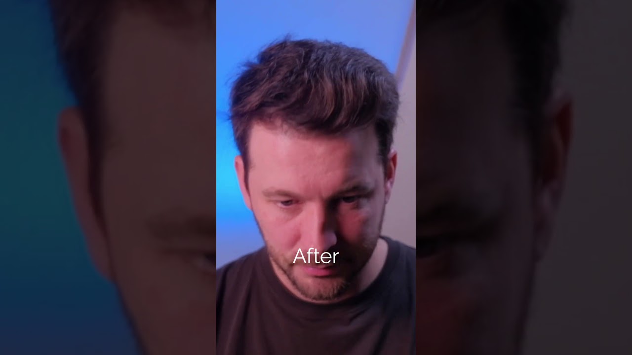 Crown Balding SOLUTION! Jae Pak MD Medical #hairloss #hairtreatment