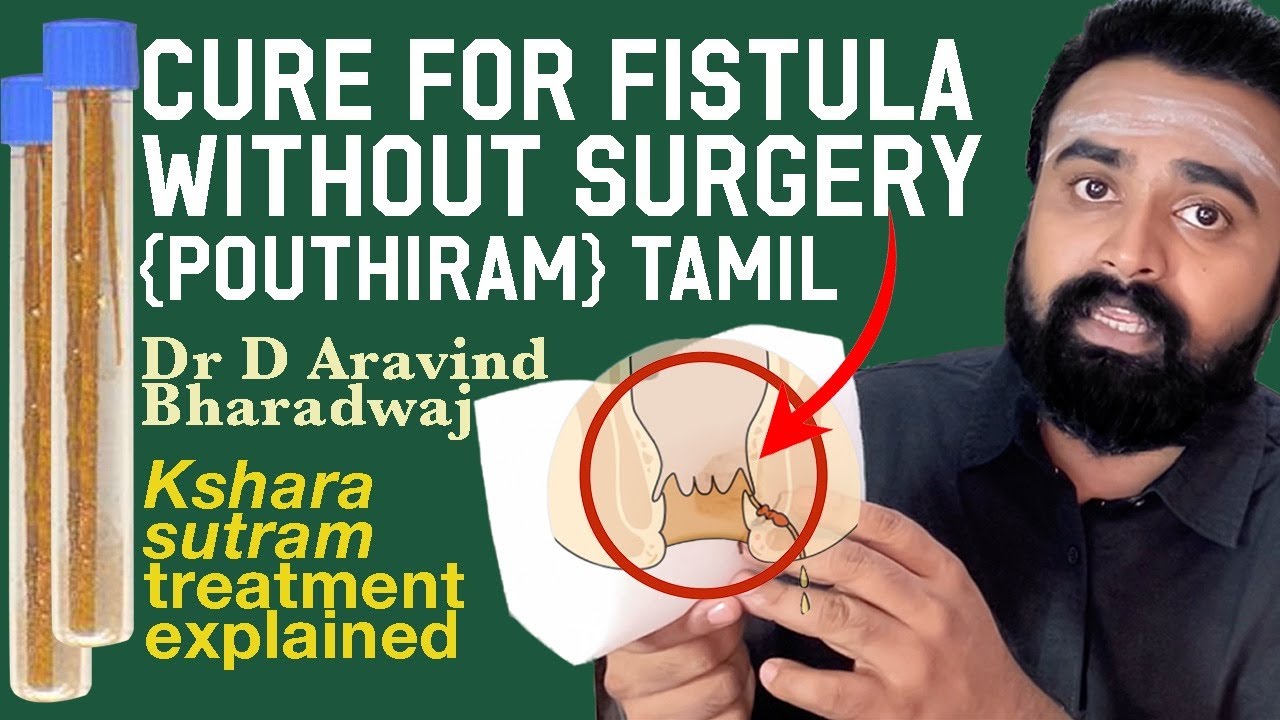 Fistula cure in Ayurveda I பௌத்திரம் நோயை அறுவை சிகிச்சையின்றி குணப்படுத்தலாம்