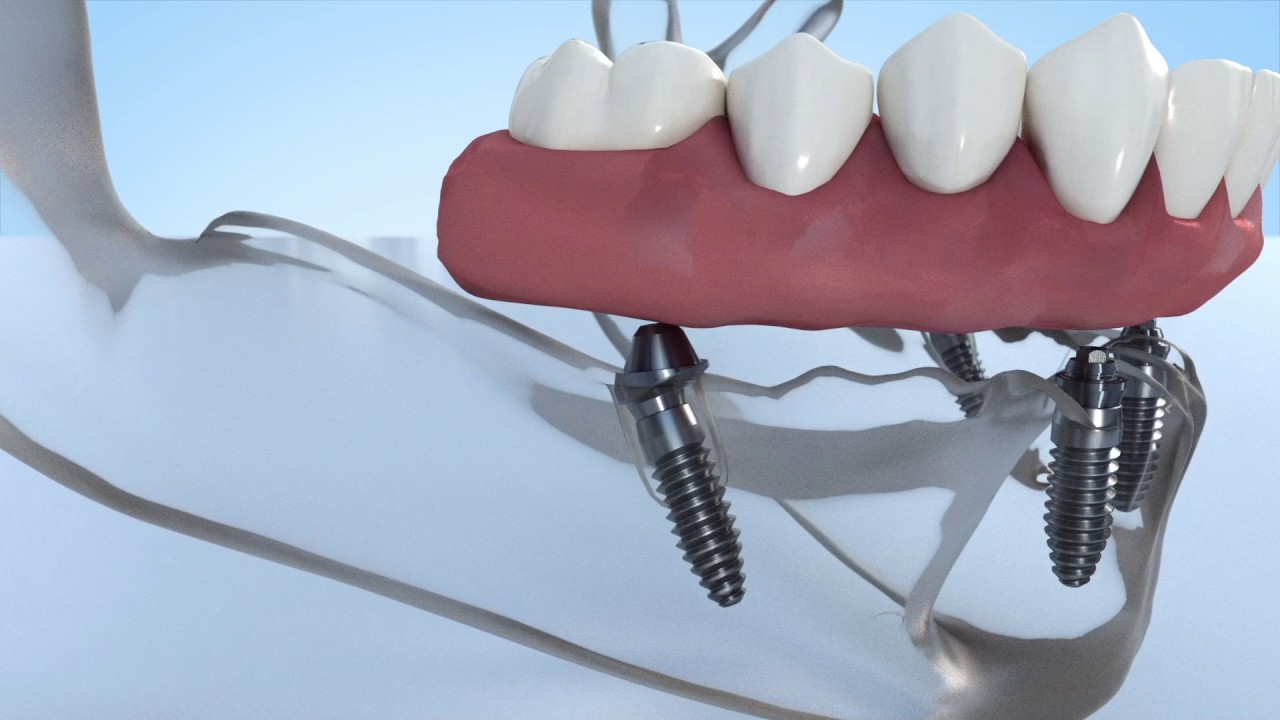 New DESS Multi-unit&reg; angulated abutment