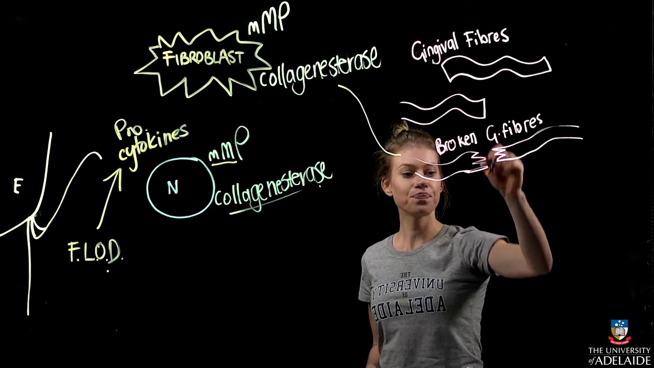 Pathogenesis of Gingivitis