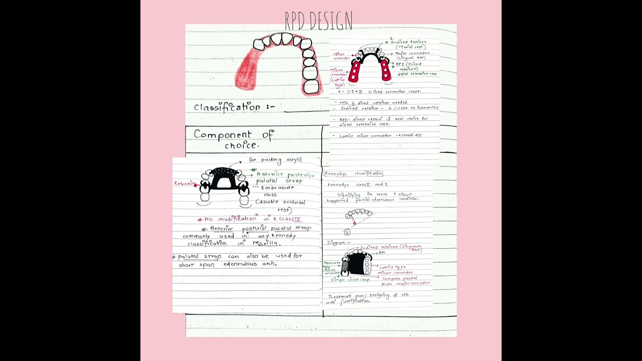 Принципы проектирования съемных частичных зубных протезов