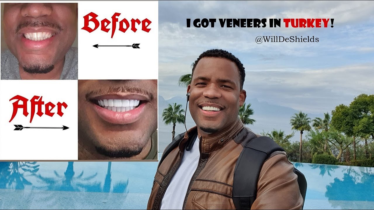 I went to Turkey to get my teeth done | My Veneers Experience