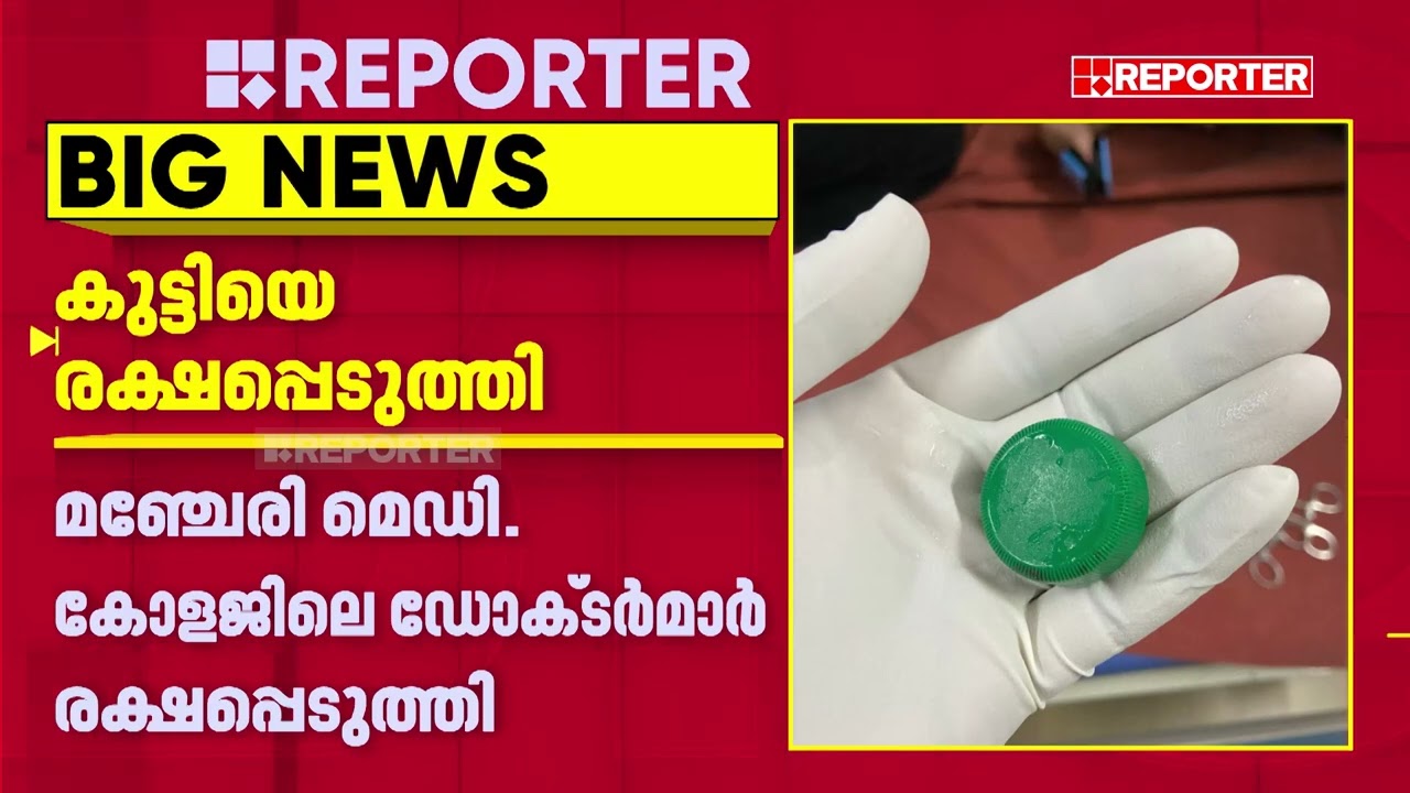 10 മാസം പ്രായമുള്ള കുട്ടിയുടെ തൊണ്ടയില്‍ അടപ്പ് കുടുങ്ങി | Malappuram
