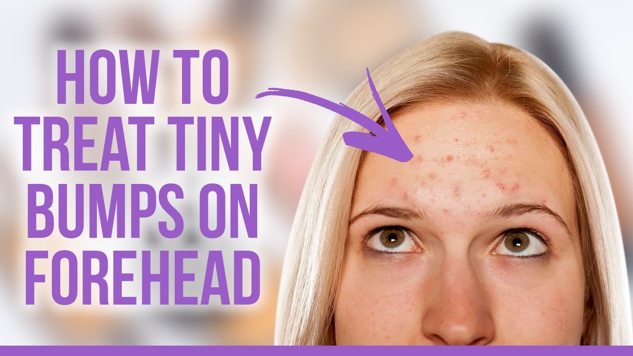 How to Treat Tiny Bumps on Forehead?