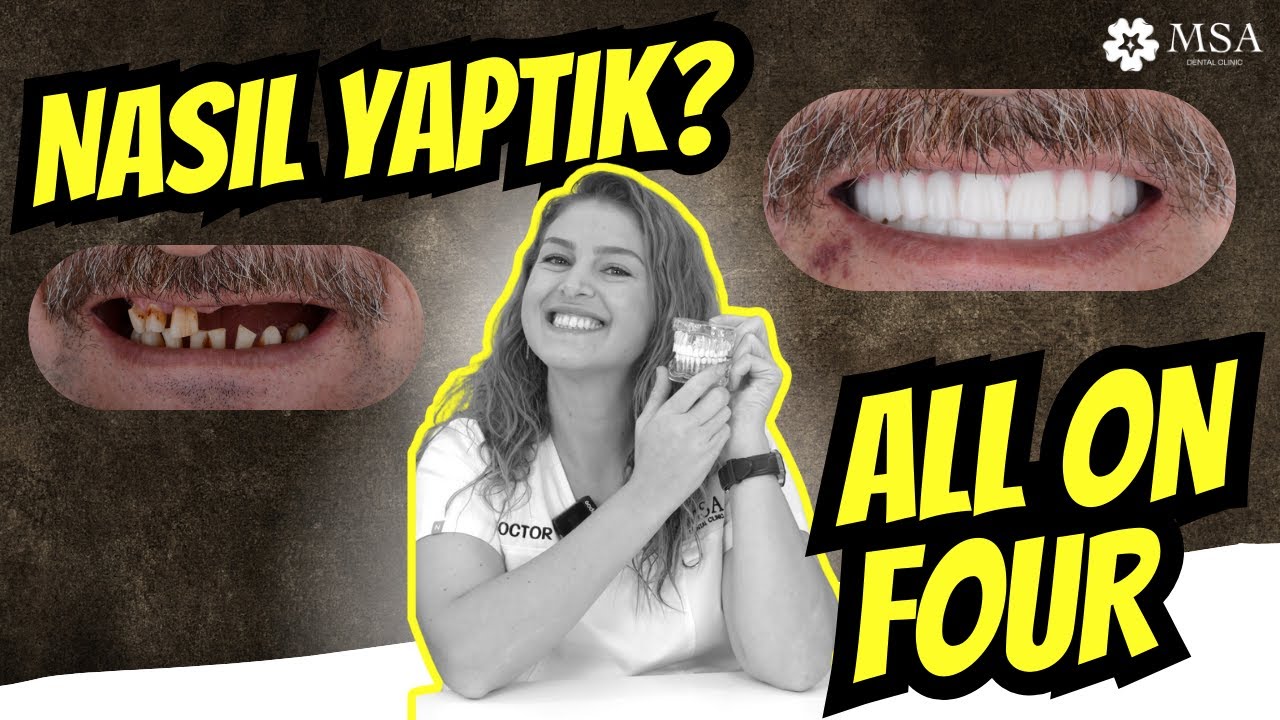 Dişsiz Bir Ağızdan Bembeyaz Bir Gülüşe: ALL ON FOUR Mucizesi!