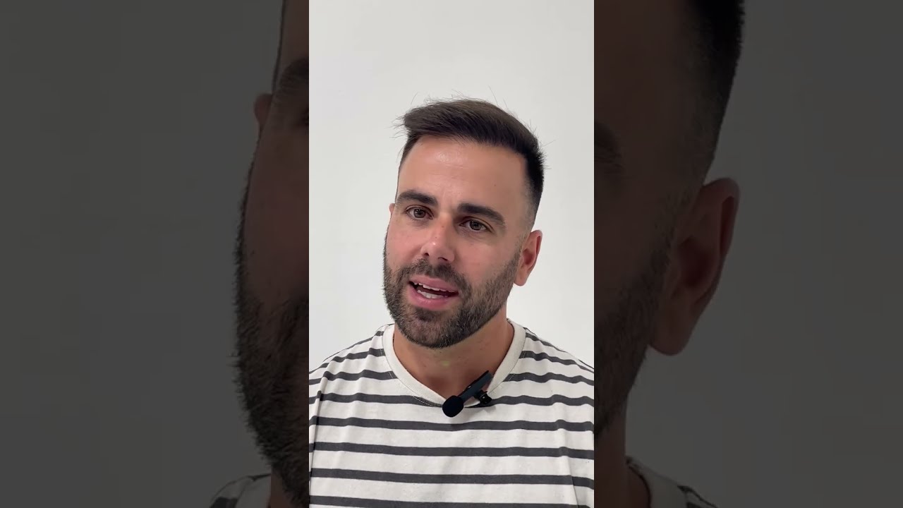 Resultado de Injerto Capilar FUE en Oliver 6 Meses Marbella Andalucía España