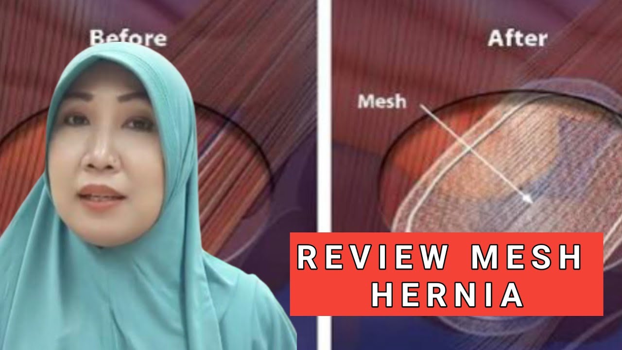 Review MEST HERNIA || BENTUK mesh Hernia