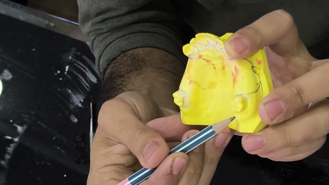 Class lll mod. 1 { design & bite & mounting Acrylic RPD , طب أسنان مرحلة ثالثة }