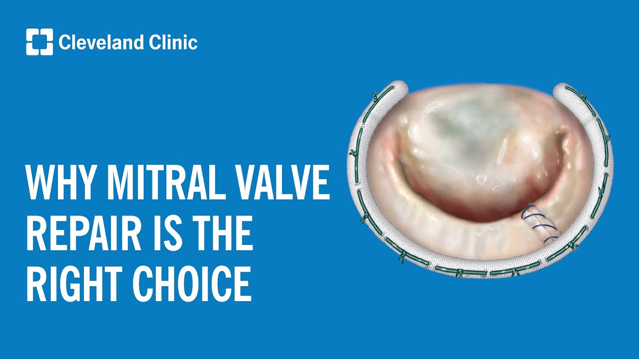 Why Mitral Valve Repair Is the Right Choice