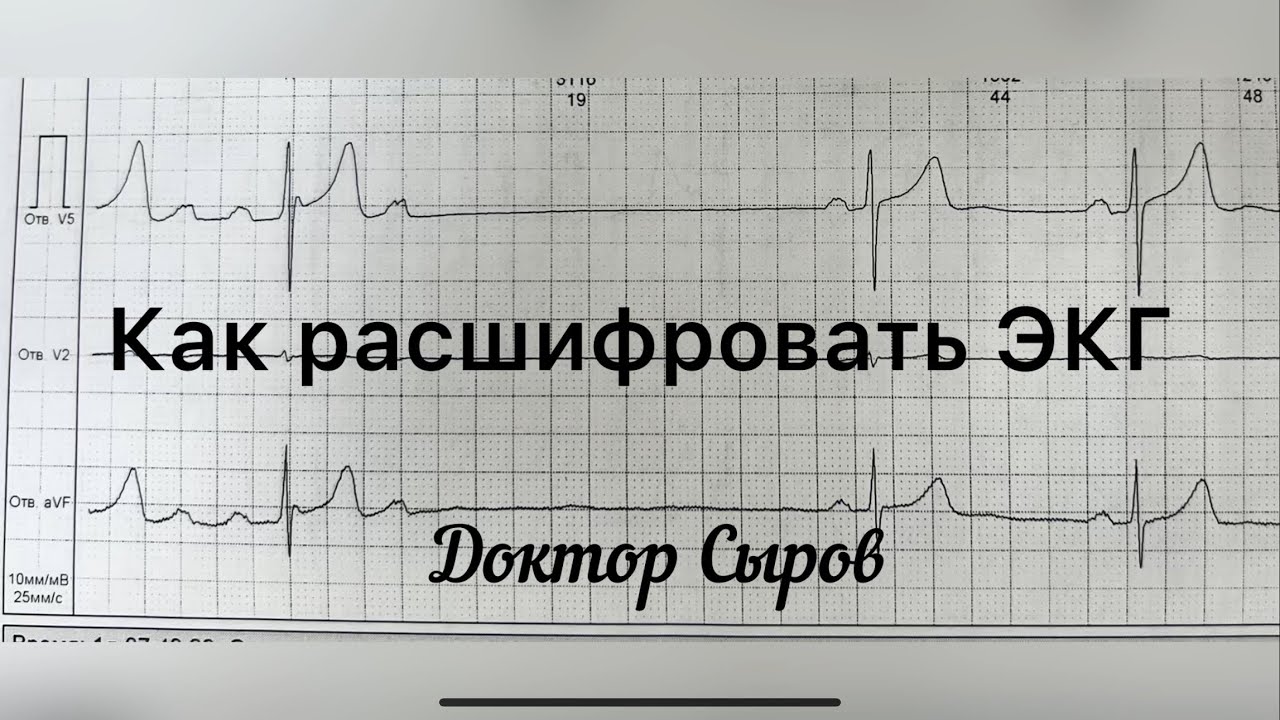 Как расшифровать ЭКГ