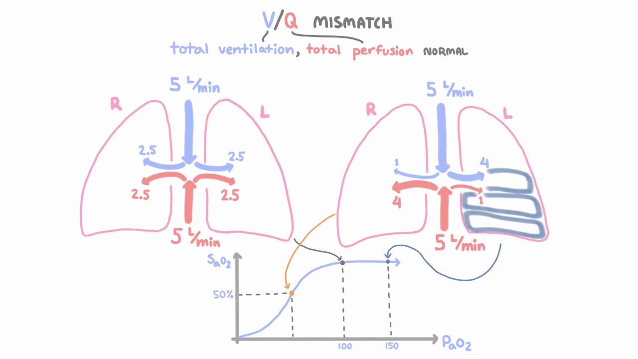 V-Q mismatch