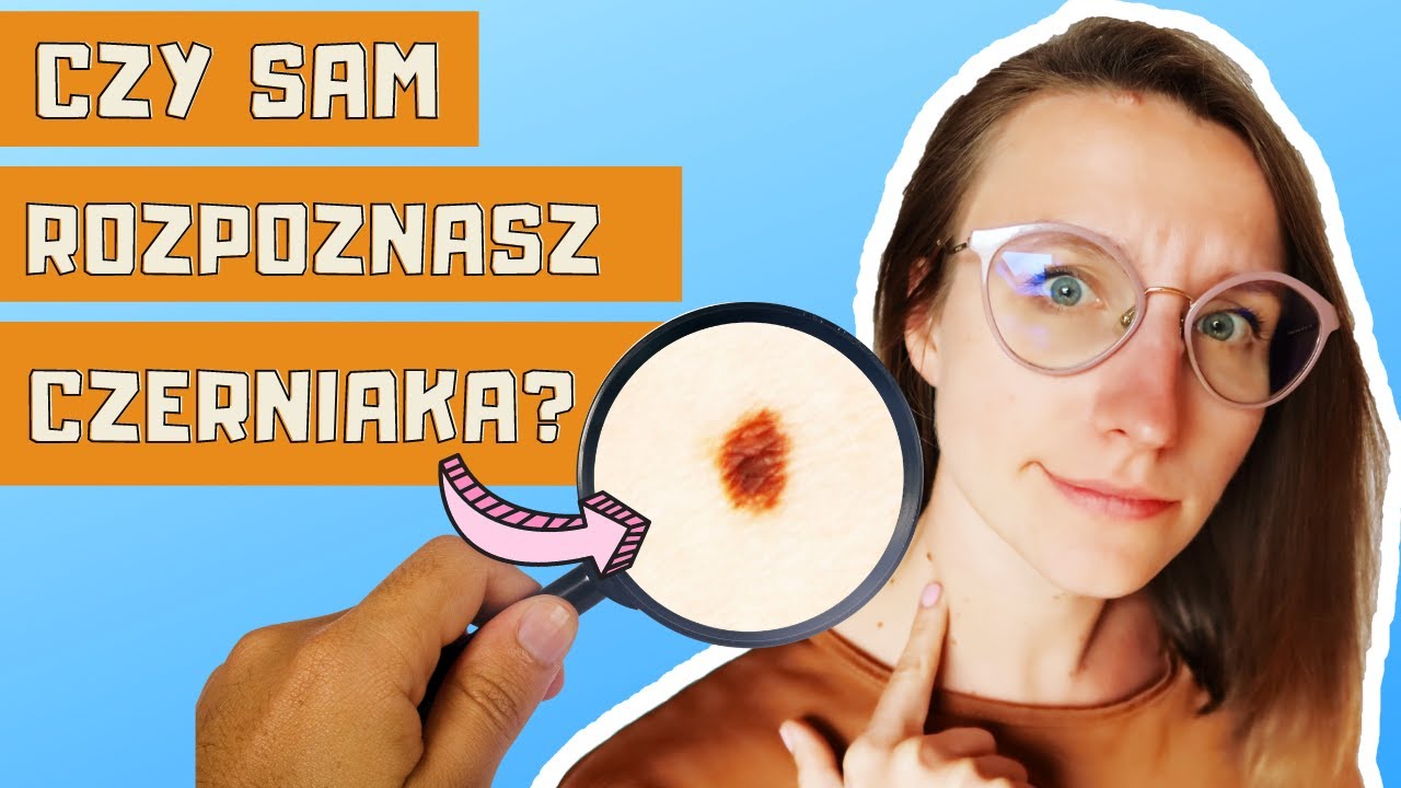 Rak skóry, czerniak – jak wygląda? 4 MITY o czerniaku! Pieprzyki na ciele – usuwać? | O, choroba!
