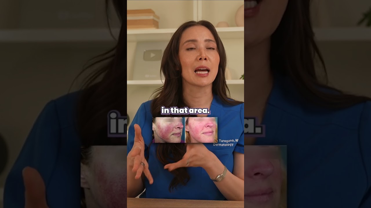 Laser Treatment for Rosacea: Part II