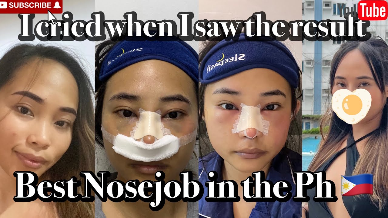 My Rhinoplasty Journey/ Philippines🇵🇭 /Worth it ba?Meraki Esthetique Dr. Joyce Regalado