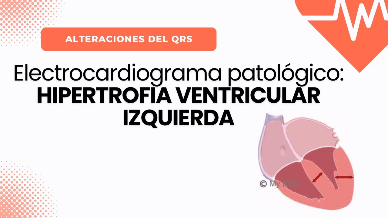 Electrocardiograma Patológico: HIPERTROFIA VENTRICULAR IZQUIERDA