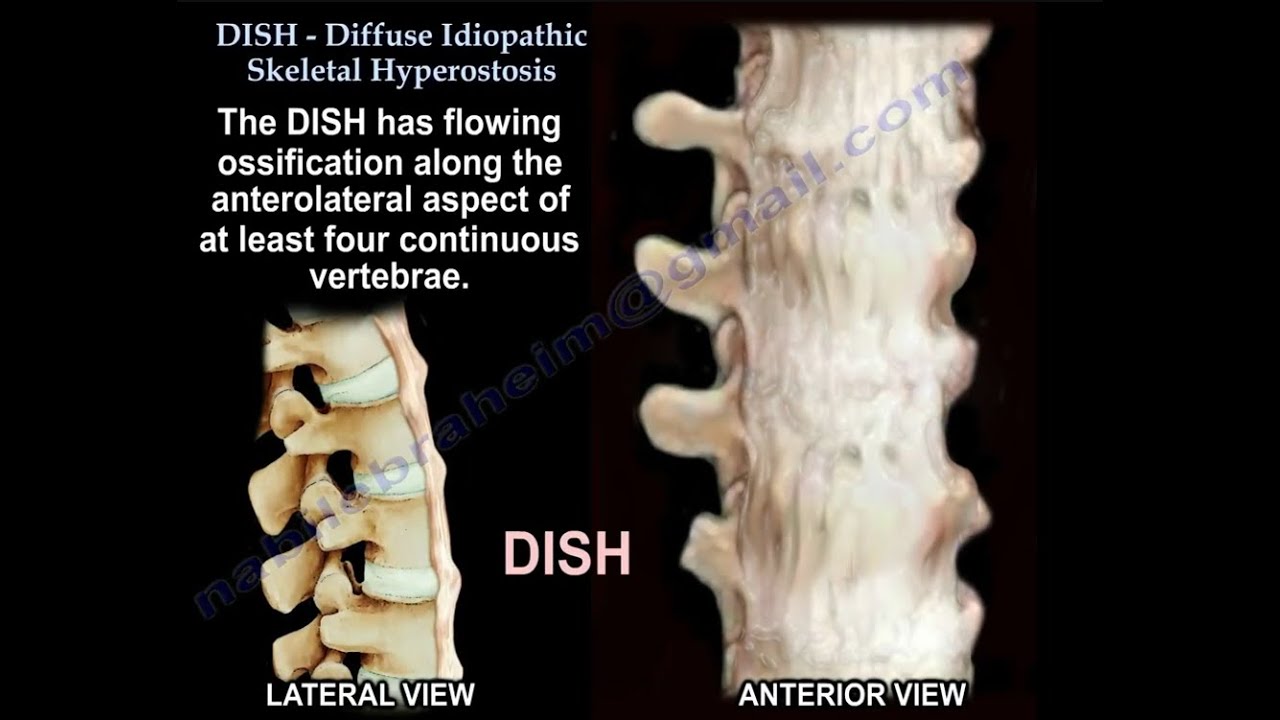 Diffuse Idiopathic Skeletal Hyperostosis (DISH) and the Key Differences from Ankylosing Spondylitis