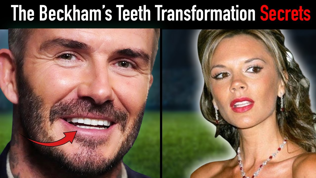 Beckham Smile Transformation Revealed: Braces or Veneer?