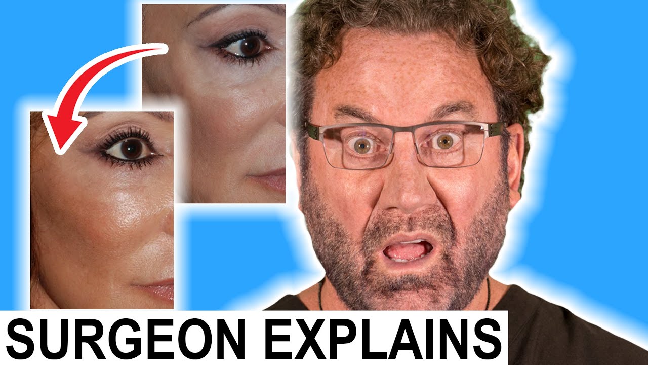 Uncovering the Differences Between Malar Bags and Festoons with a Plastic Surgeon