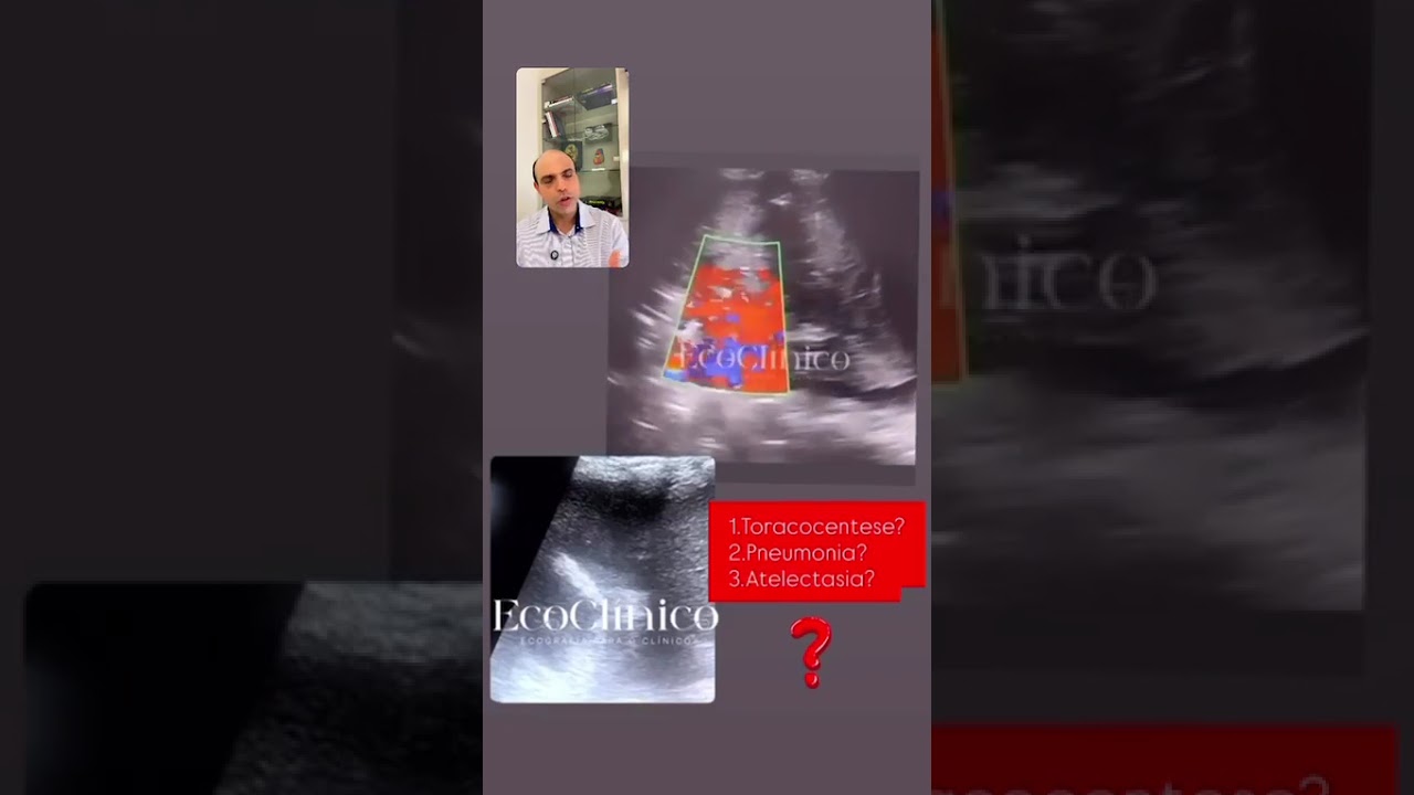 Live 15/01: Pneumonia x atelectasia 