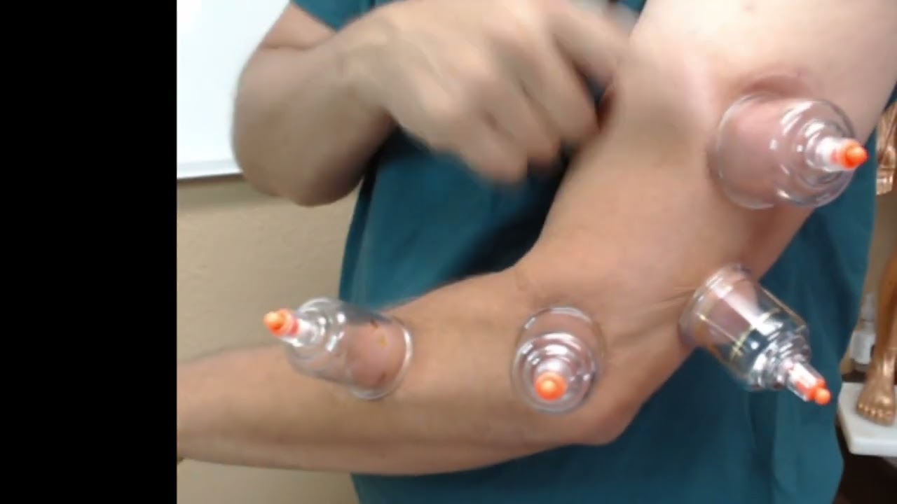 elbow cupping lateral epichondylitis