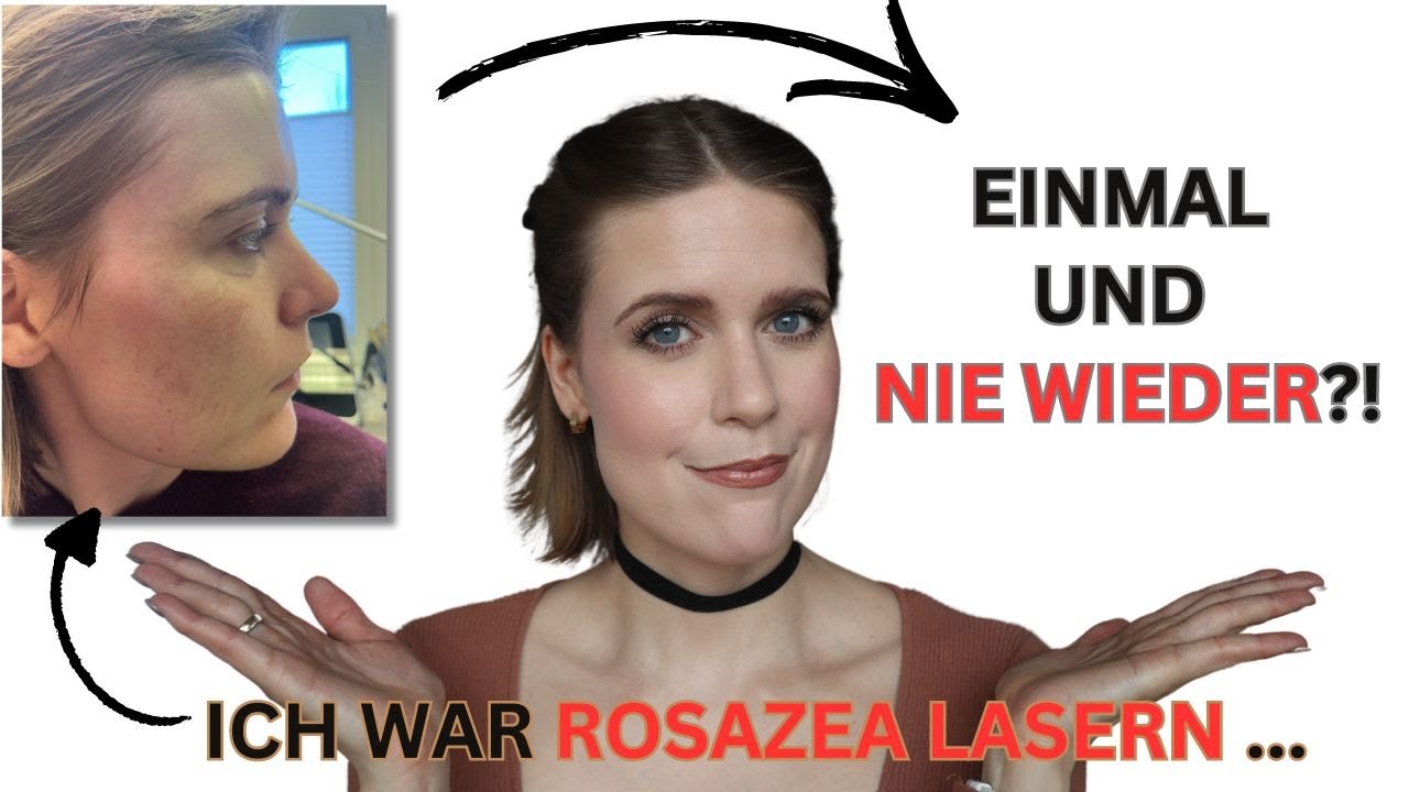 ROSAZEA LASERN VORHER-NACHHER  |  ROSAZEA LASERBEHANDLUNG - MEINE ERFAHRUNGEN