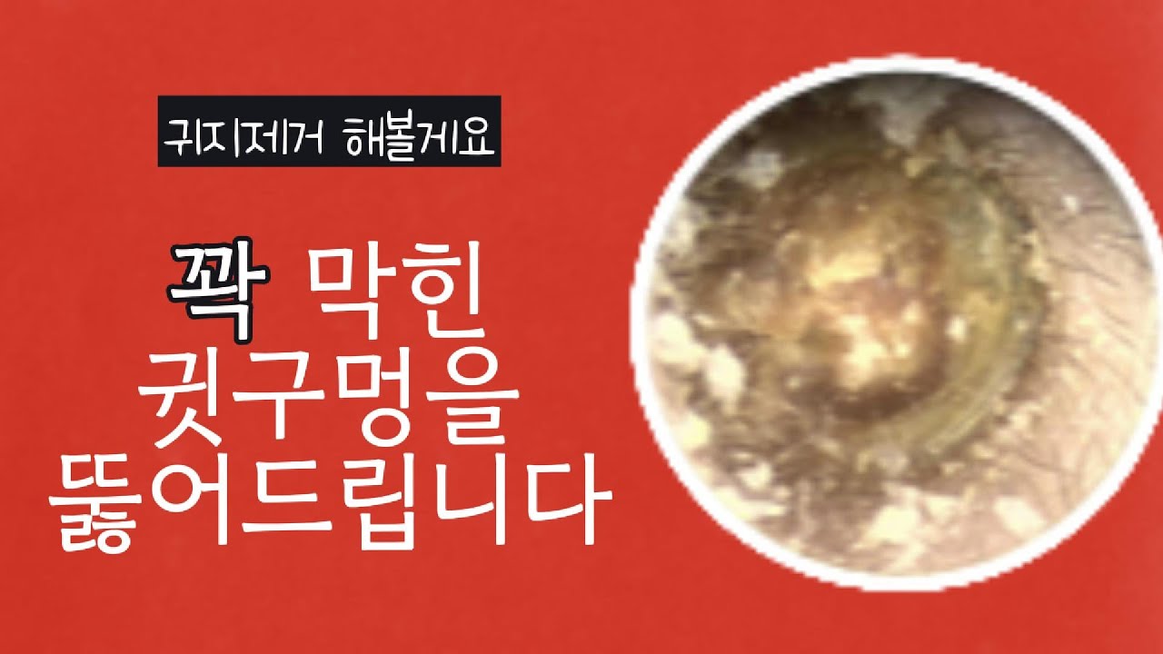 꽉 막힌 귓구멍을 뚫어드립니다(Earwax removal from both ears/Remo&ccedil;&atilde;o de cera dos dois ouvidos)