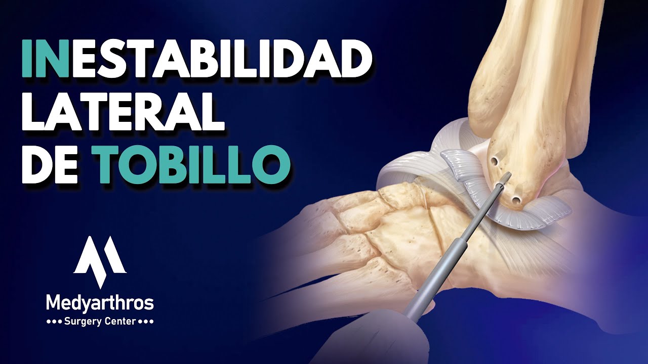 Inestabilidad Lateral de Tobillo