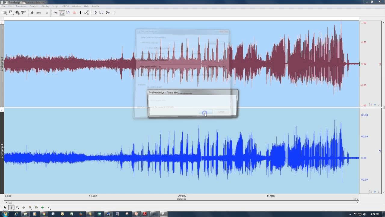 Seizure Detection