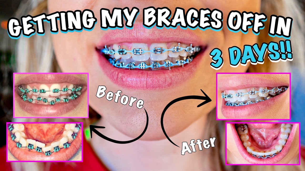 LAST BRACES UPDATE *im getting them off* COLOR CHANGE, BEFORE/AFTER PICS, & ELASTICS | Brice Larimer